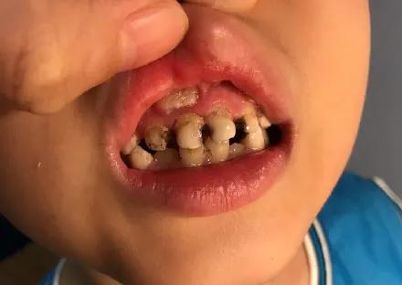 4岁孩子的一口牙,全烂光了!