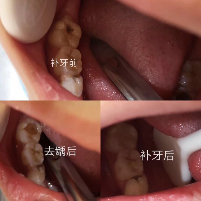 絲路合和口腔科普烏魯木齊牙齒矯正為何要經歷洗牙補牙拔牙這三步