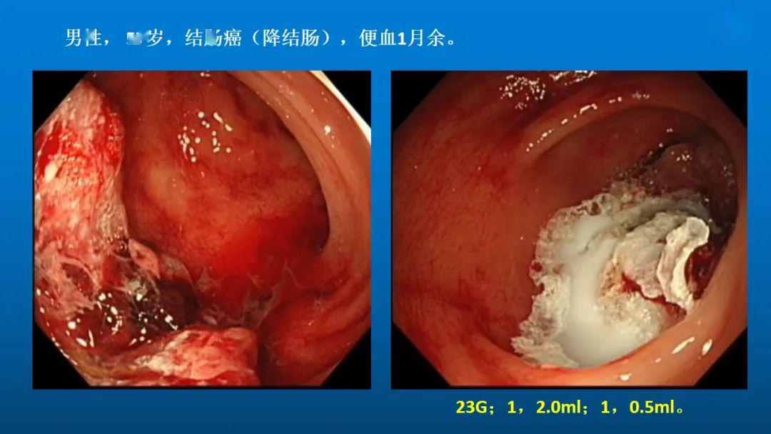 教學ppt消化道晚期惡性腫瘤出血的內鏡治療