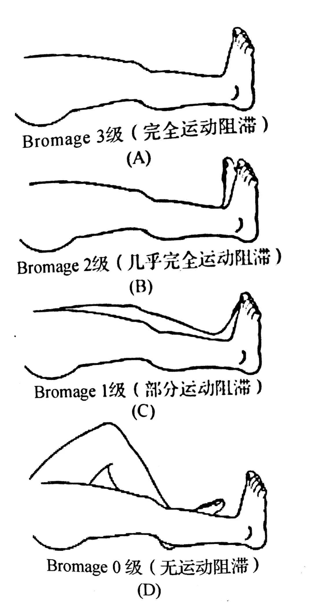 bromage评分法是用来评估硬膜外镇患者下肢运动阻滞程度的工具,在国外