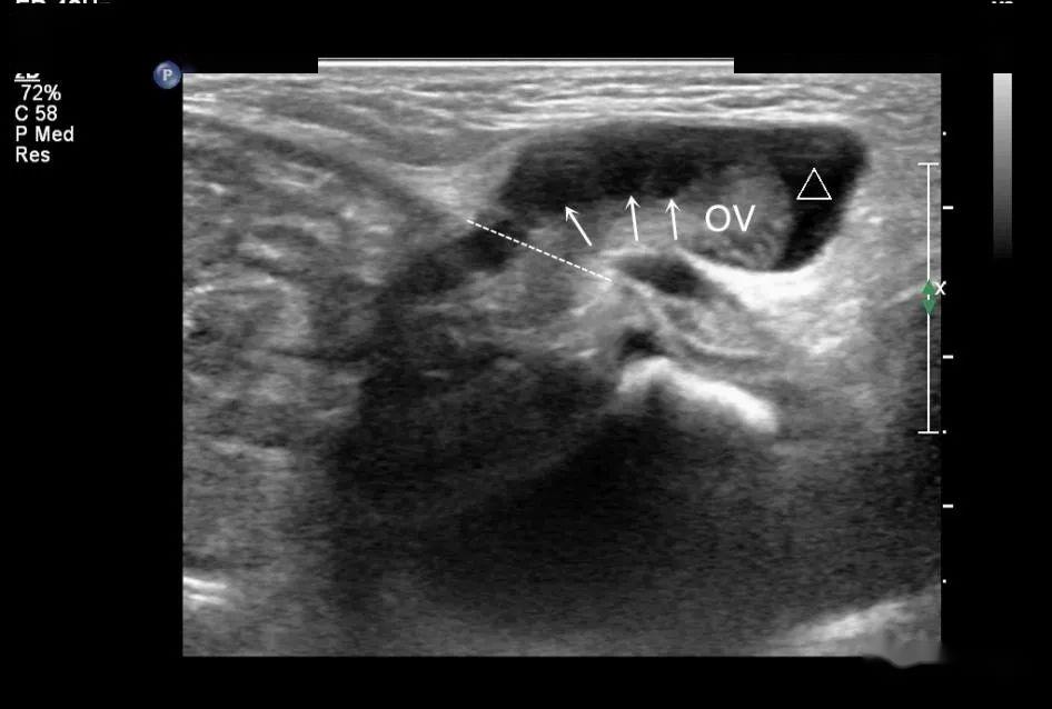 超声提示 左侧腹股沟疝