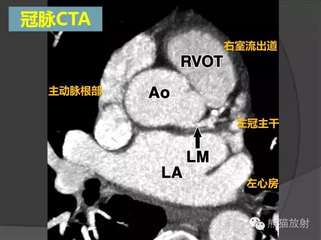 冠状动脉CTA图解图片