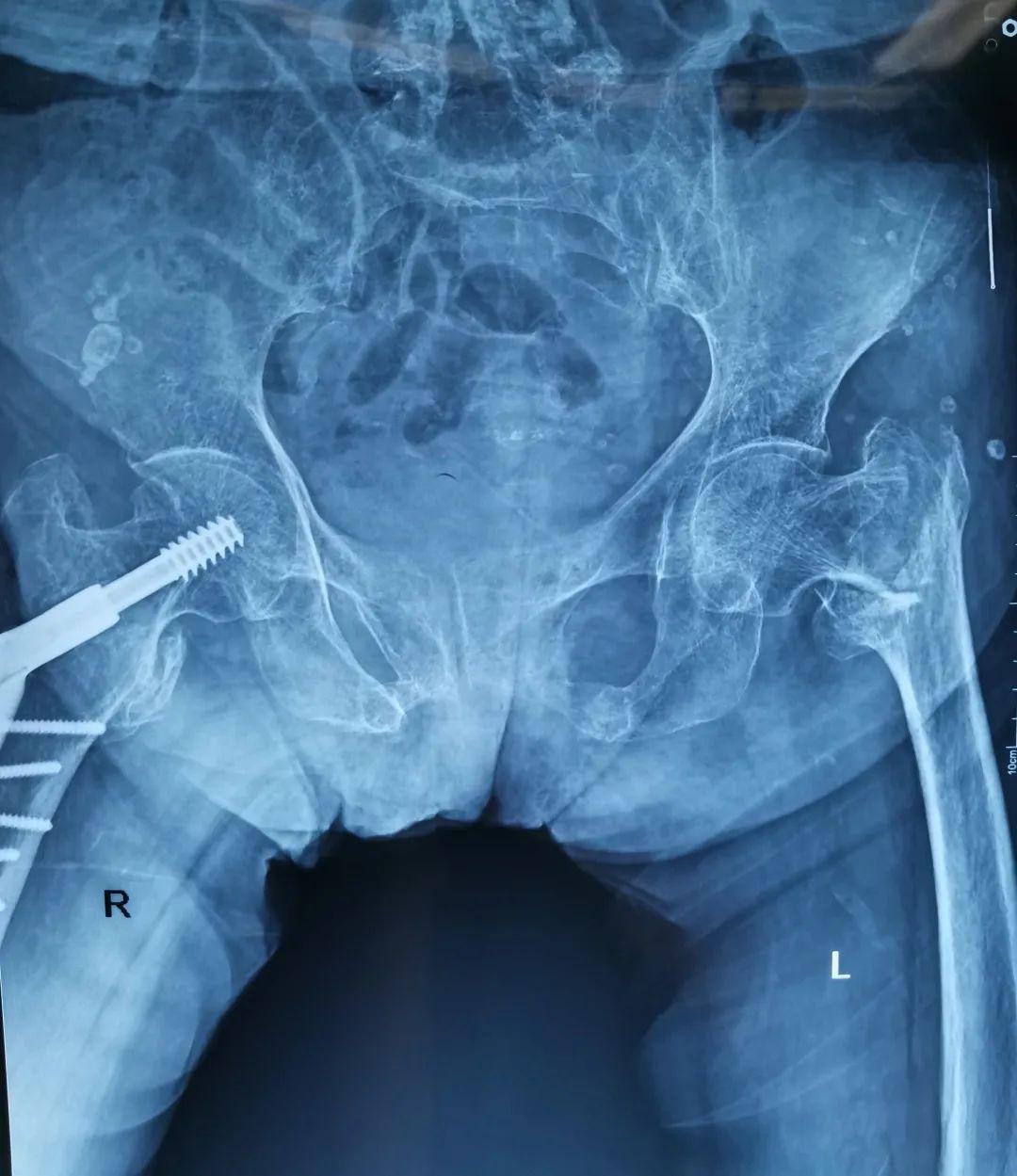 市第一医院骨一科助力老年髋部骨折患者战胜人生最后一次骨折