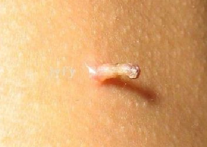 丝状疣是发生于皮肤浅表的外形如丝的小赘生物,俗称线瘊
