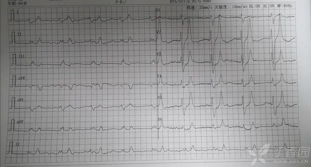 如此完美的高鉀心電圖血鉀竟然51mmoll
