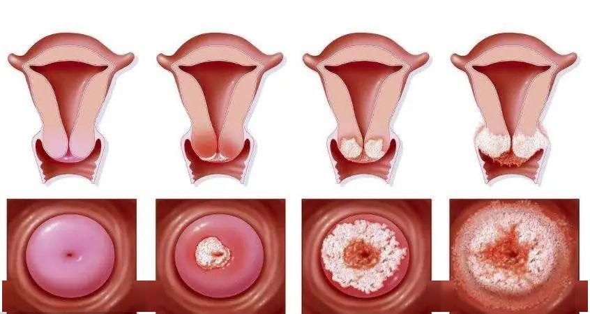 宫颈癌晚期掉烂肉图片图片
