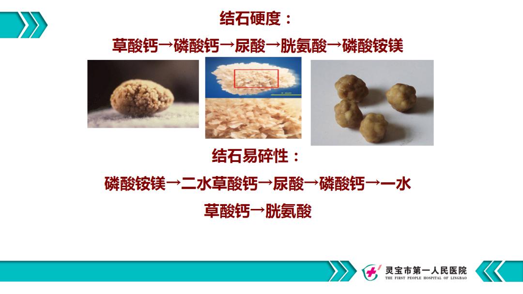 灵一健康泌尿系结石你了解吗