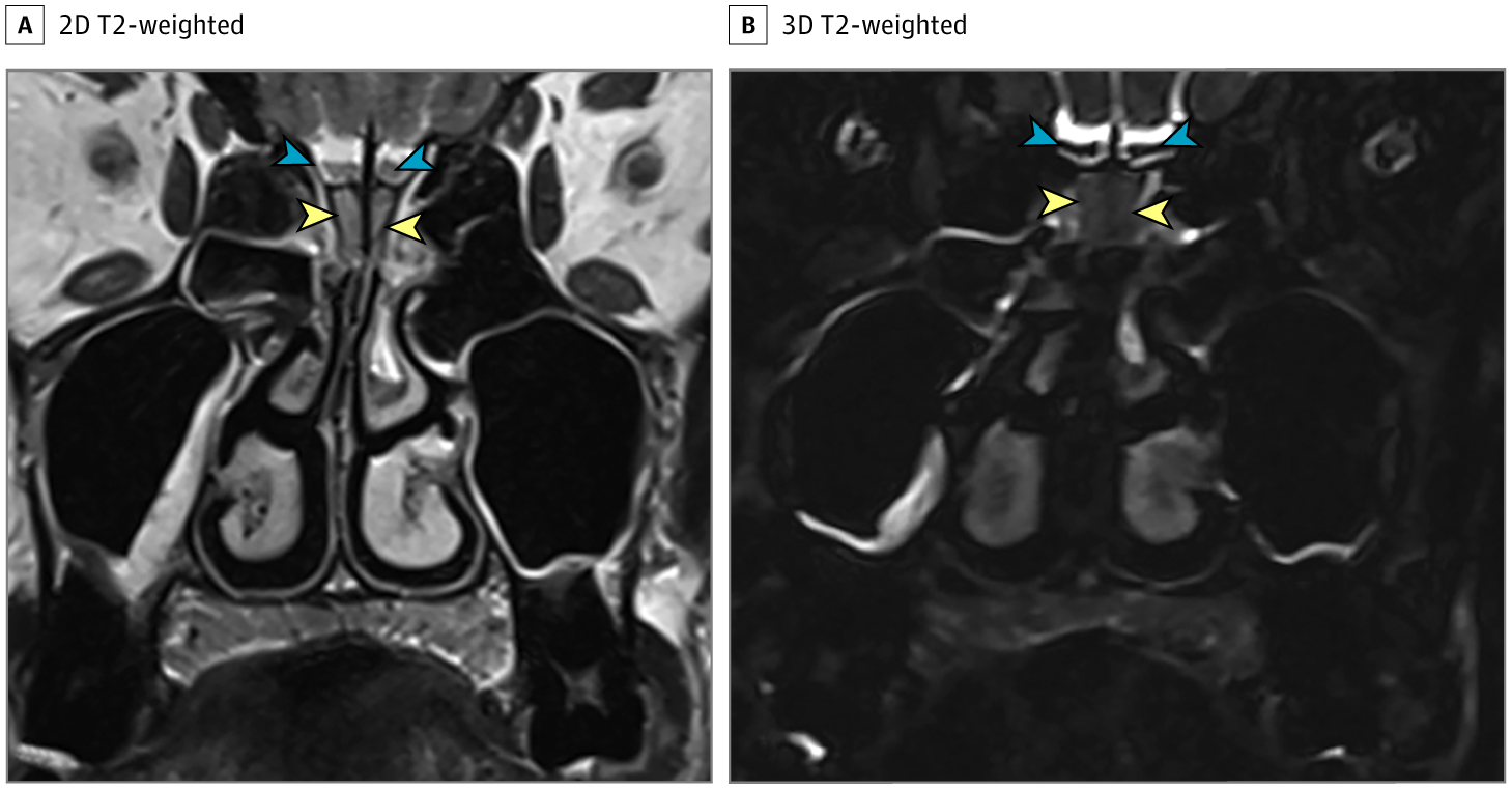 图1患者接受了鼻腔ct检查(图1),显示双侧嗅裂区的炎性阻塞,经鼻腔mri