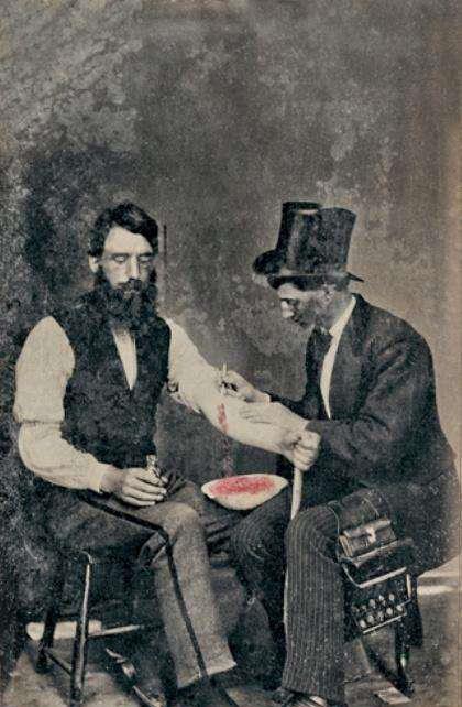 放血疗法历史长达数千年,虽然很少起作用,却始终存在_华盛顿