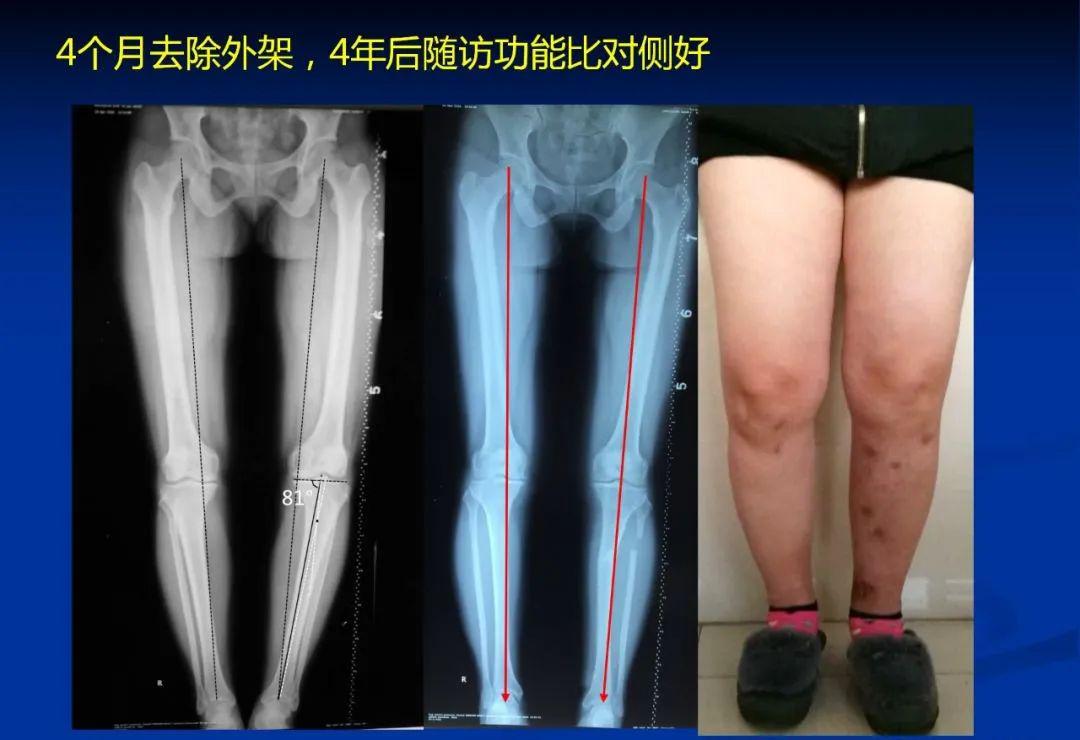 内翻膝骨性关节炎的力学机理和截骨治疗