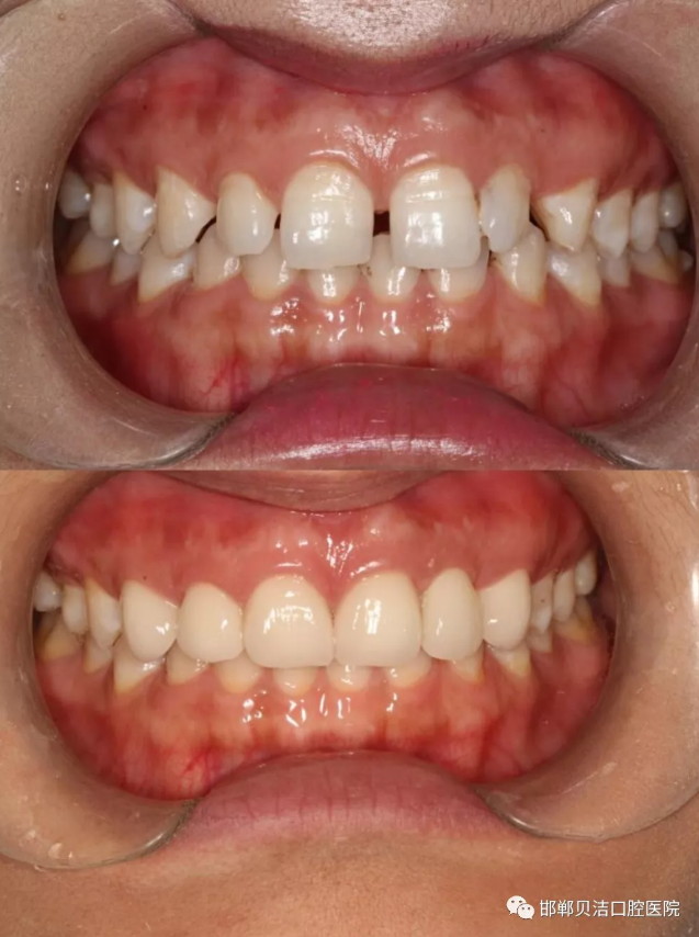 不论哪种修复方式,在调整前,最好检查清楚是哪种原因造成的牙缝过大