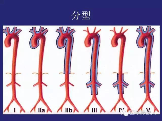 大动脉炎分型及ct诊断