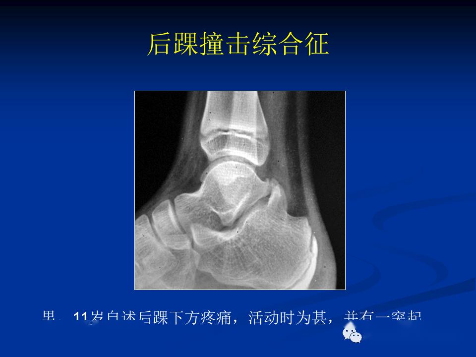 距骨喙突撞击图片