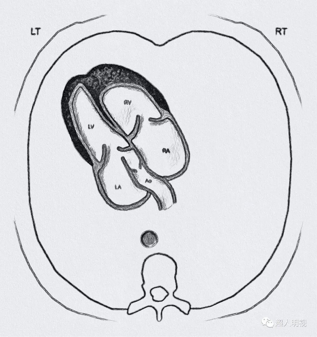 左心室流出道解剖图片
