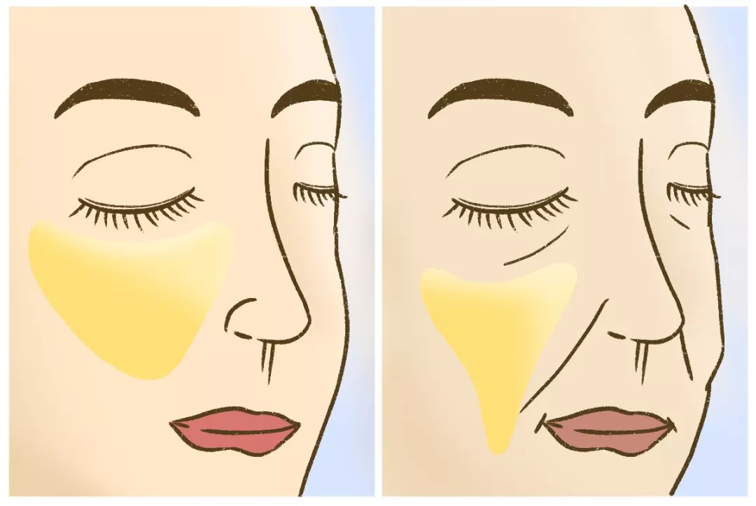 法令纹是怎么出现的去除法令纹的护肤技巧有哪些