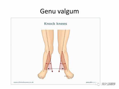 膝外翻胫骨内踝间距图图片