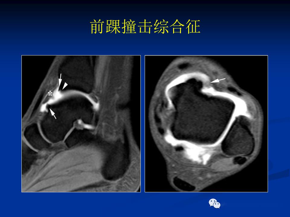 撞击综合征 来自搜狐网