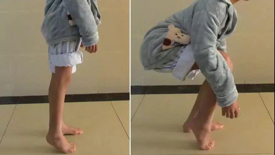 儿康进行时第49期先天性马蹄内翻足尽早治疗改变孩子一生