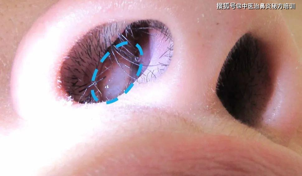 原创鼻息肉很难治那是因为大多数患者选择的治疗方法不正确看看正确的