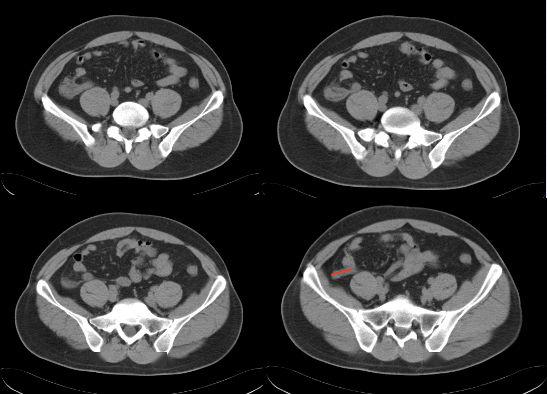 回肠后位:在回肠后位,指向脐;5.