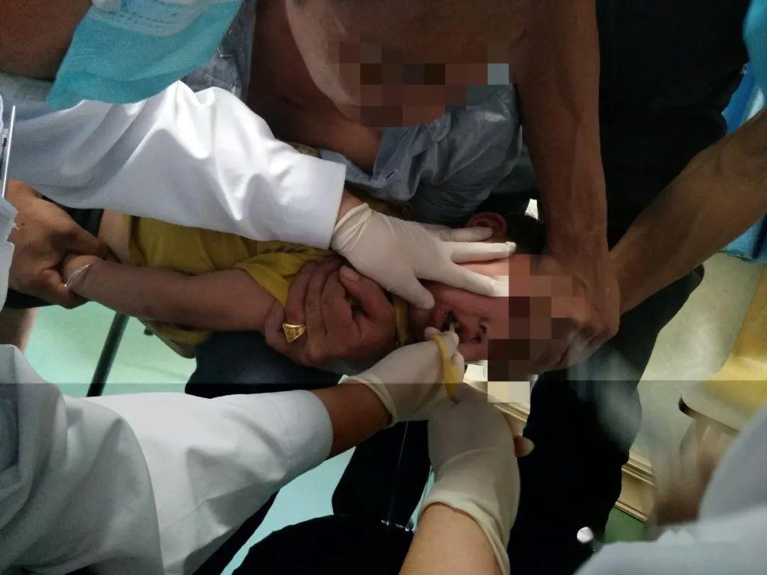 危险!4岁孩子误吞硬币,德昌医生巧用气囊导尿管成功取出