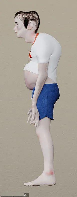 因为戴耳机时间长,脑袋也出现了凹陷手指一直操作键盘鼠标或手机所以