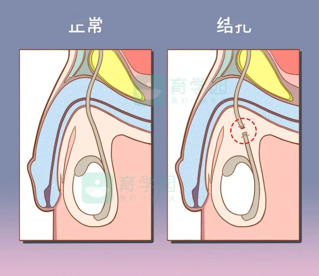 避孕想一劳永逸?那得需要男人出点力