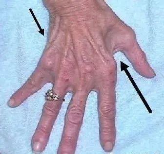 手麻不一定都是颈椎病也有可能是因为这个