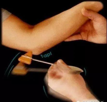 3,夹纸试验(froment征)阳性:嘱患者用患侧食指与拇指捏夹一张纸,患侧