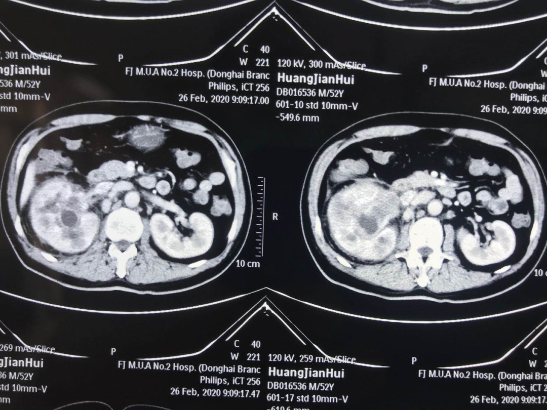 巨大肾盂癌覆灭记步步惊心从下不了手到顺利摘下