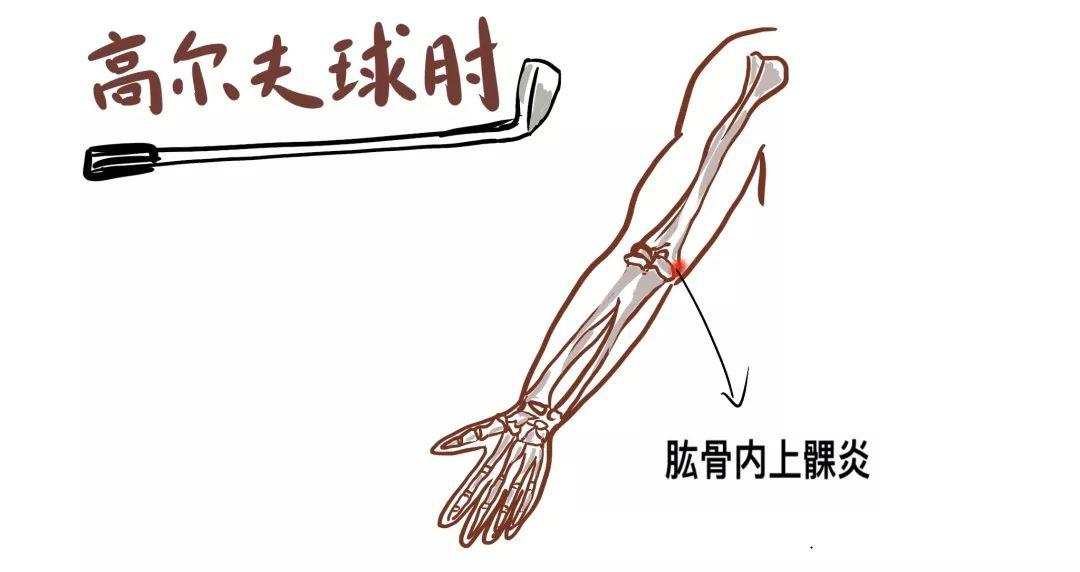 网球肘 解剖图图片