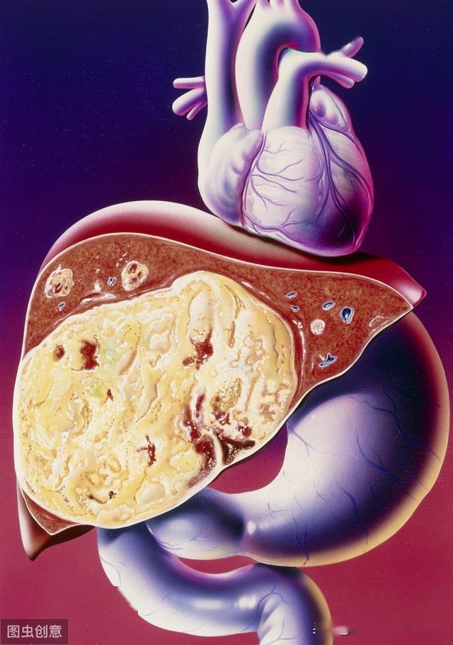 肝癌到底选择肝切除,还是肝移植?_肿瘤