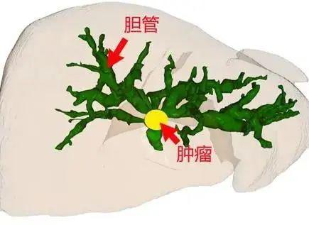 (肝門部膽管癌位置示意圖)目前國內外關於腹腔鏡下肝門膽管癌手術開展