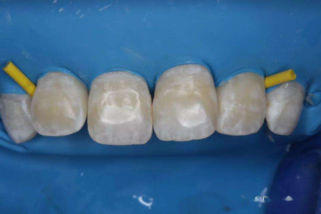 病例分享渗透树脂治疗氟斑牙前牙一例