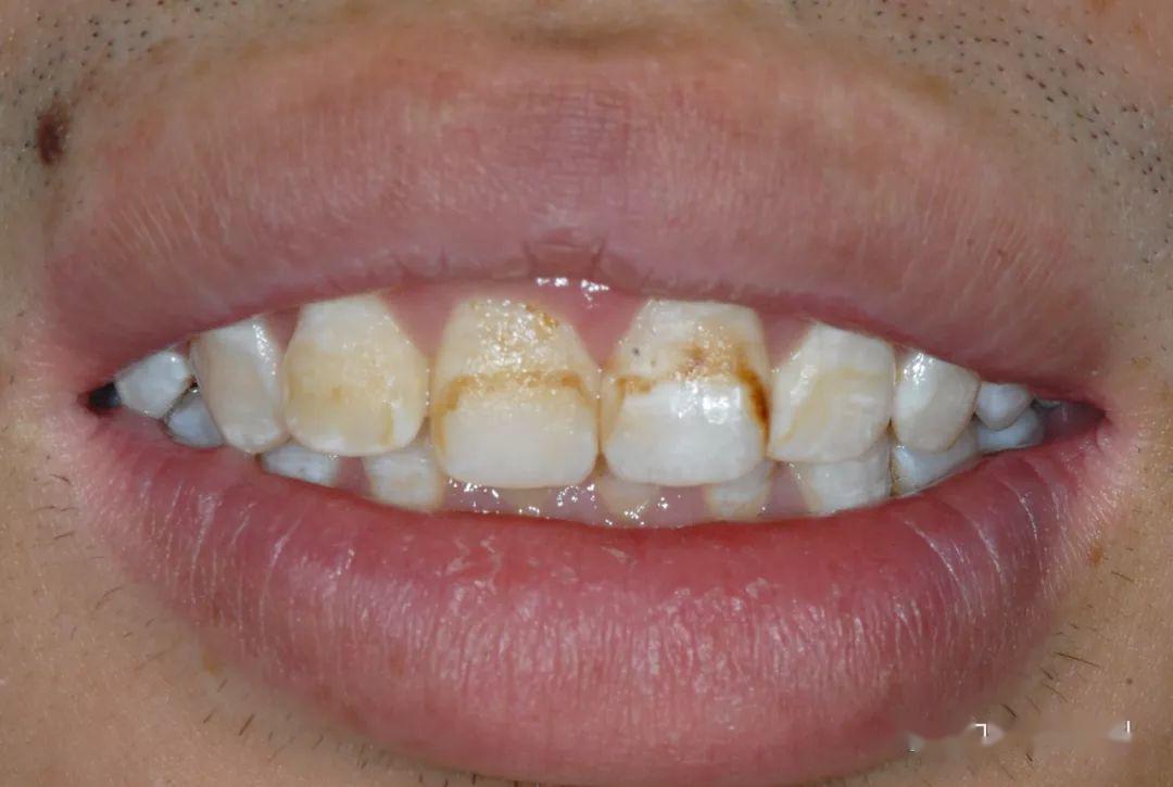 【病例分享】渗透树脂治疗氟斑牙前牙一例