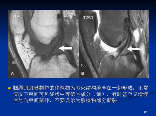 孟悛非教授半月板和前交叉韌帶術後的mri評價