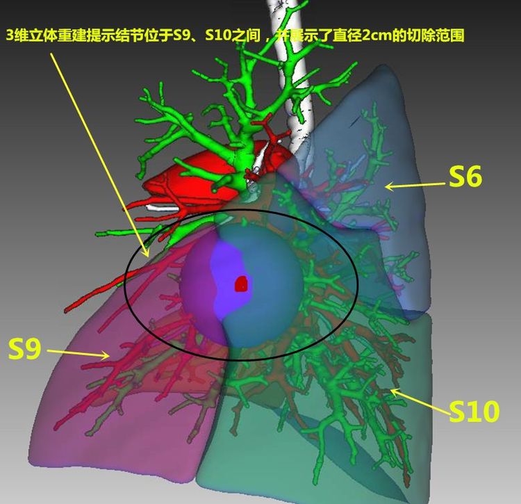 術前胸部增強ct薄掃後三維重建,可見結節位於左肺下葉外,後基底段之間