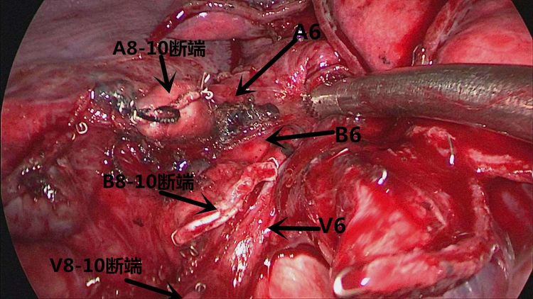 醫療資訊胸腔鏡下解剖性肺段切除術