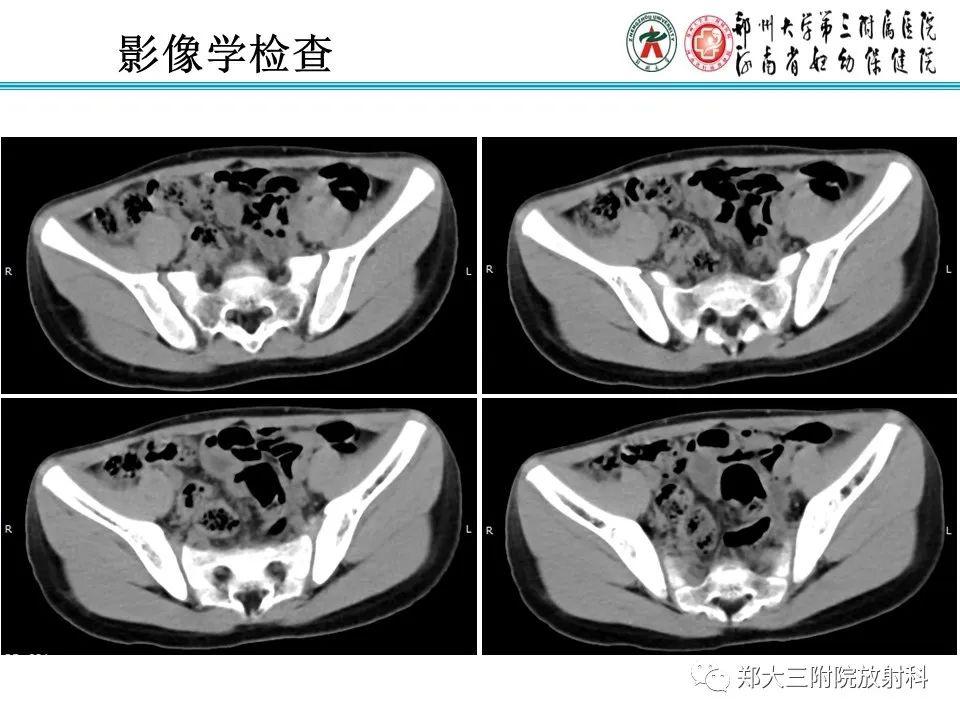 梅克尔憩室超声图表现图片