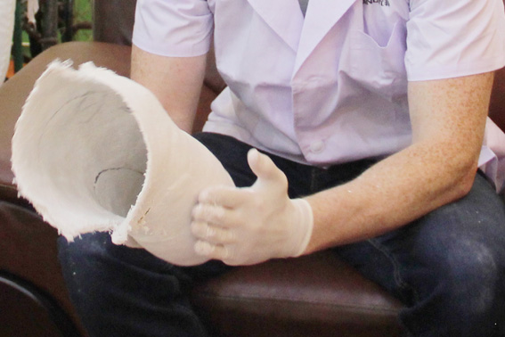 优邦假肢-糖尿病截肢患者怎么选择假肢