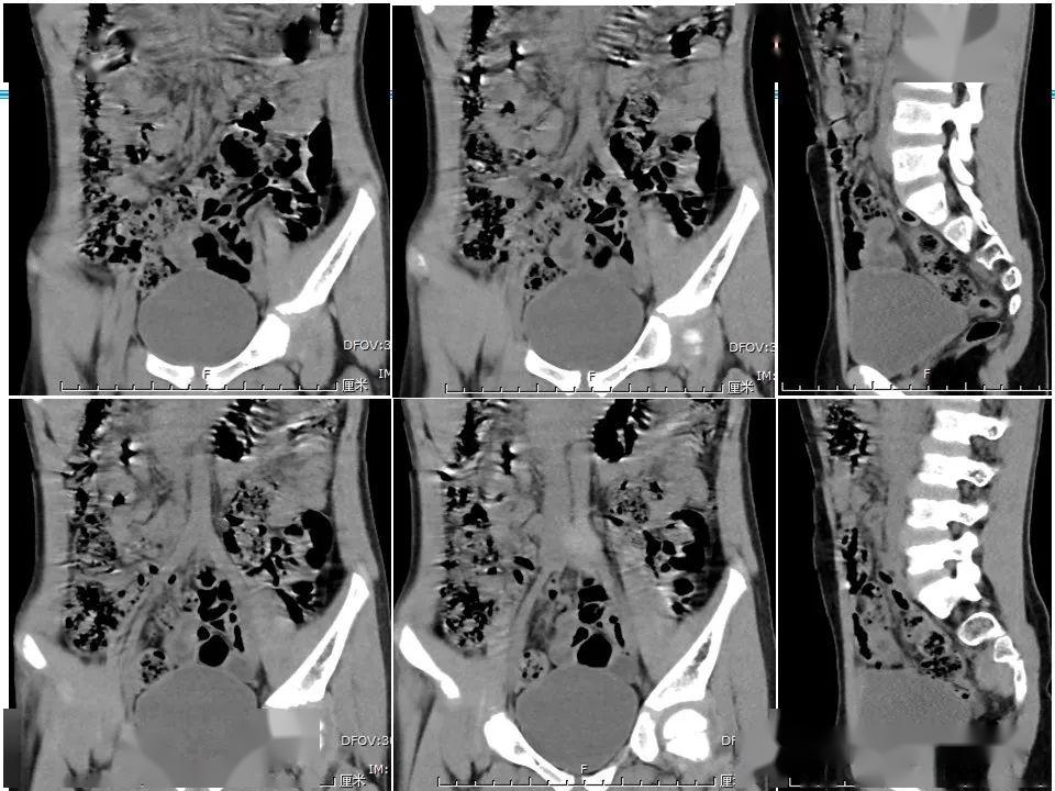 每日一例1052梅克尔憩室影像诊断