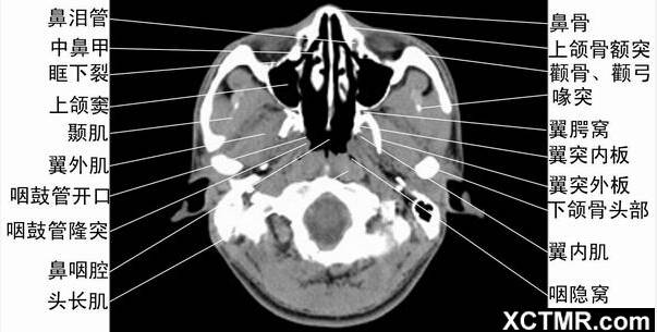 解剖图片ct轴位鼻腔和鼻窦层面(蝶窦水平) 