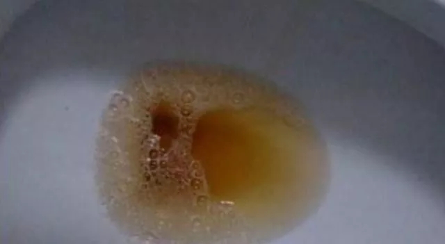 胆红素结晶尿图片图片