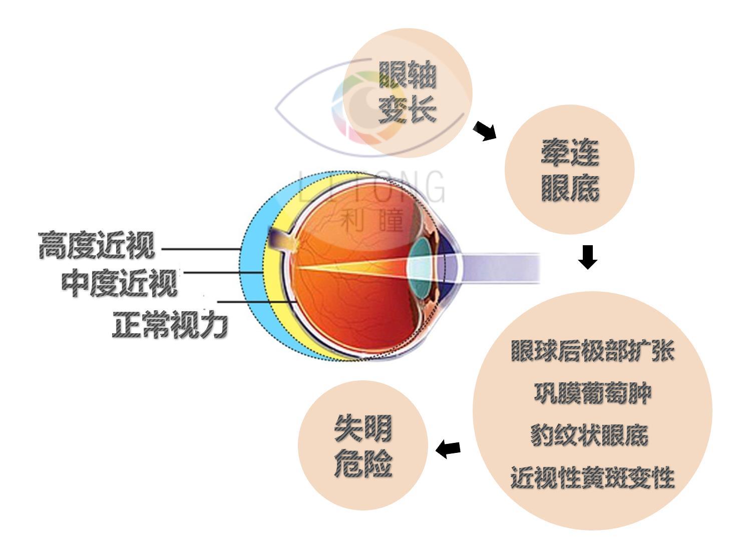 包括白内障,视网膜脱落,黄斑裂孔,青光眼等眼病的发病率会急剧升高