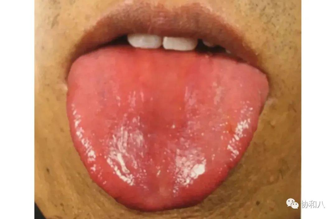 牛肉舌:左滑高能预警小细胞肺癌在镜下表现为小圆形的癌细胞,细胞质少