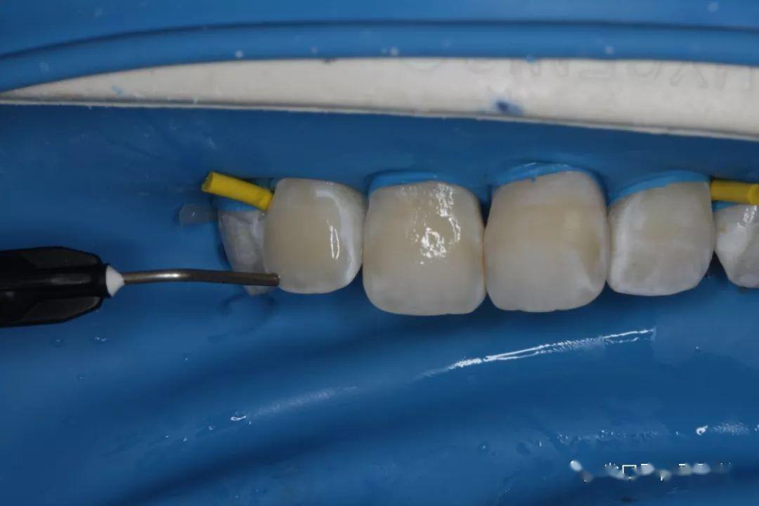 病例分享渗透树脂治疗氟斑牙前牙一例