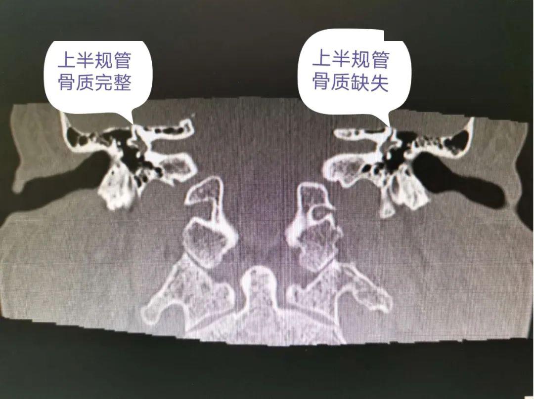 周永青介绍说,上半规管裂综合征是一种罕见病,由于上半规管骨质缺裂