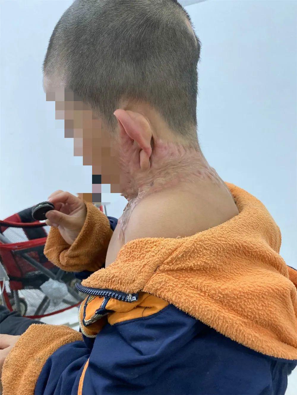 太可怜了永嘉6岁男孩严重烫伤急需手术治疗盼大家伸出援手