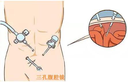 什麼是單孔腹腔鏡腹股溝疝修補術有何優勢普外科王曉亮