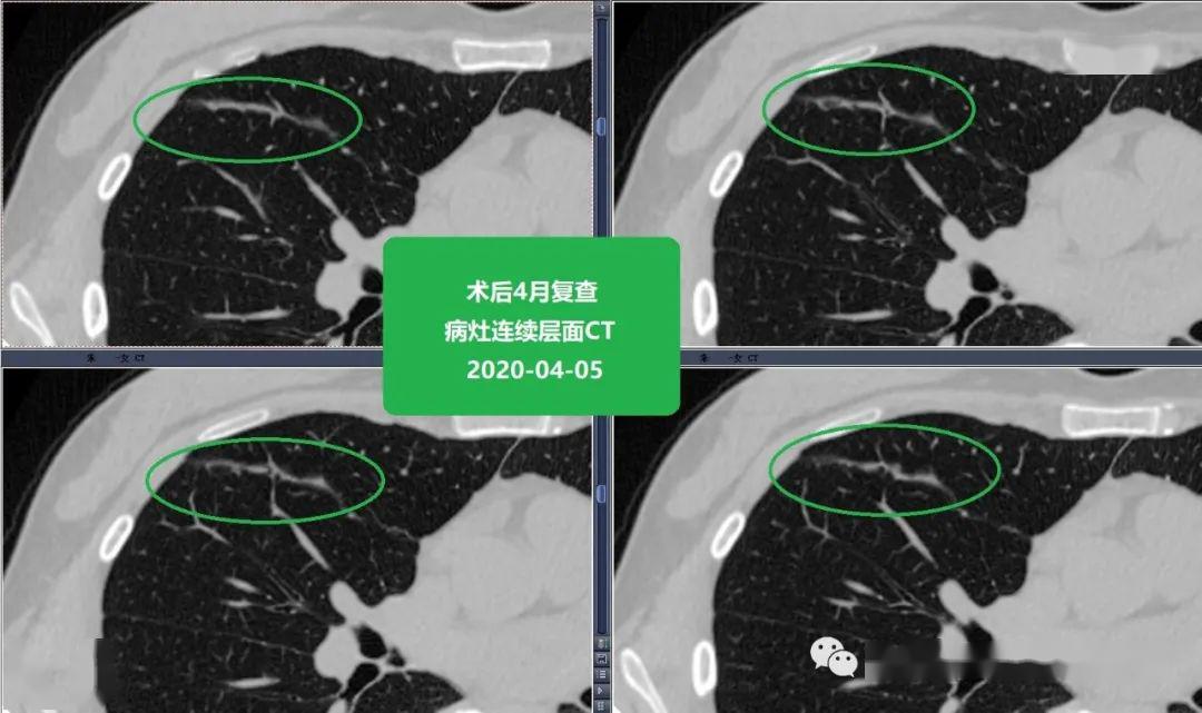 蘇大附二院靳勇醫生團隊病例分享第51期——肺磨玻璃結節的消融_治療